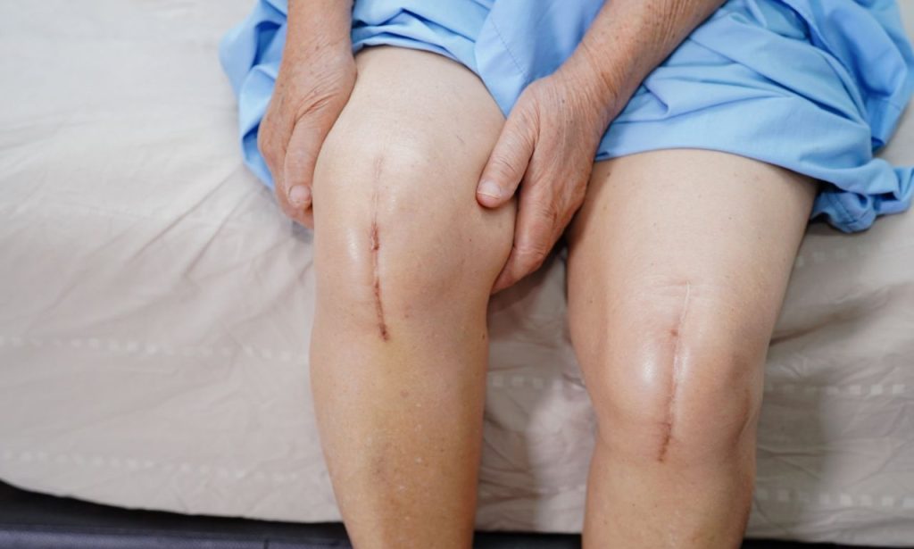 What to Expect 5 Months After Knee Replacement