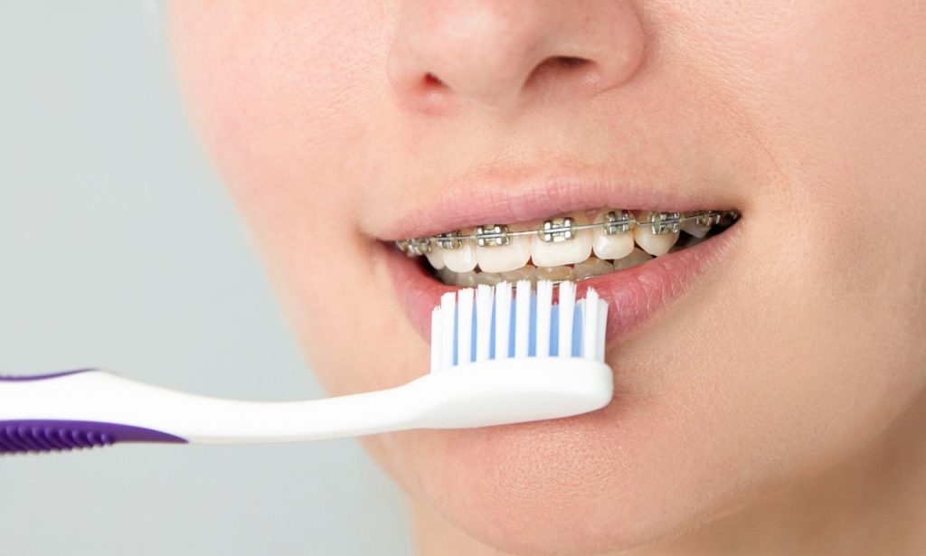 What Is the Best Toothbrush for Braces?